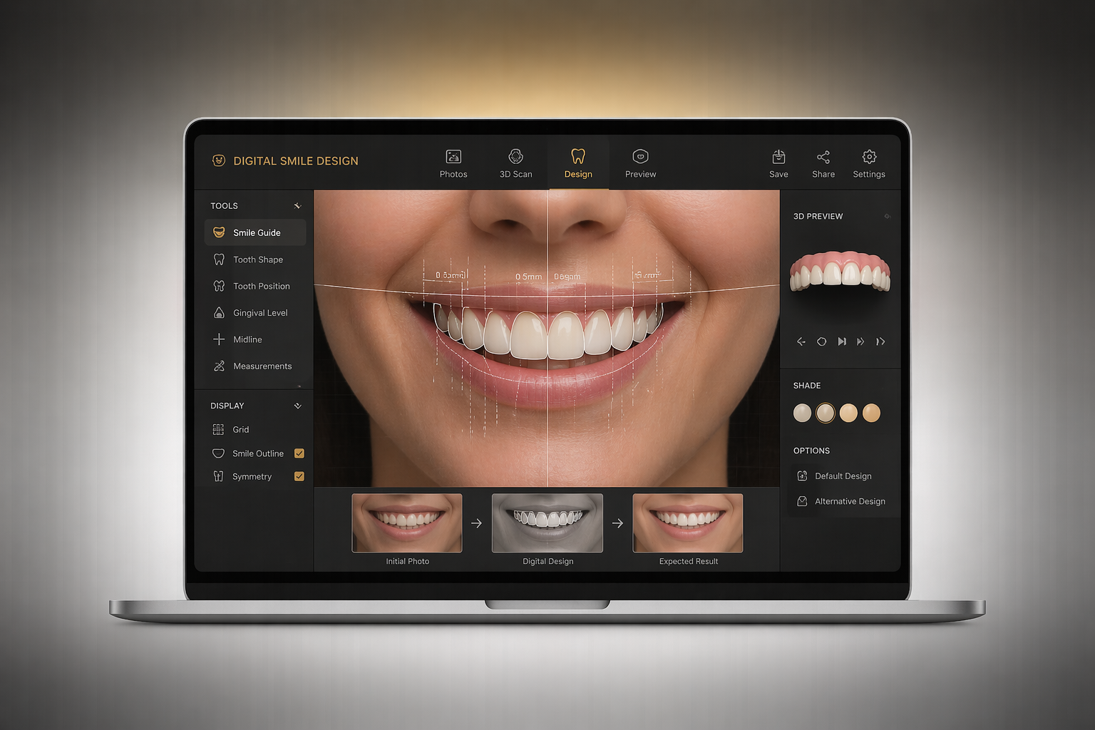 Laptop screen displaying a digital smile design program with a close-up of a person's smiling mouth and teeth, tools on the left, options on the right, and a before-and-after comparison at the bottom.