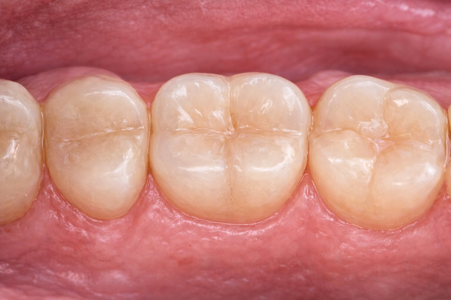 Close-up of four healthy molar teeth in the lower jaw with pink gums.
