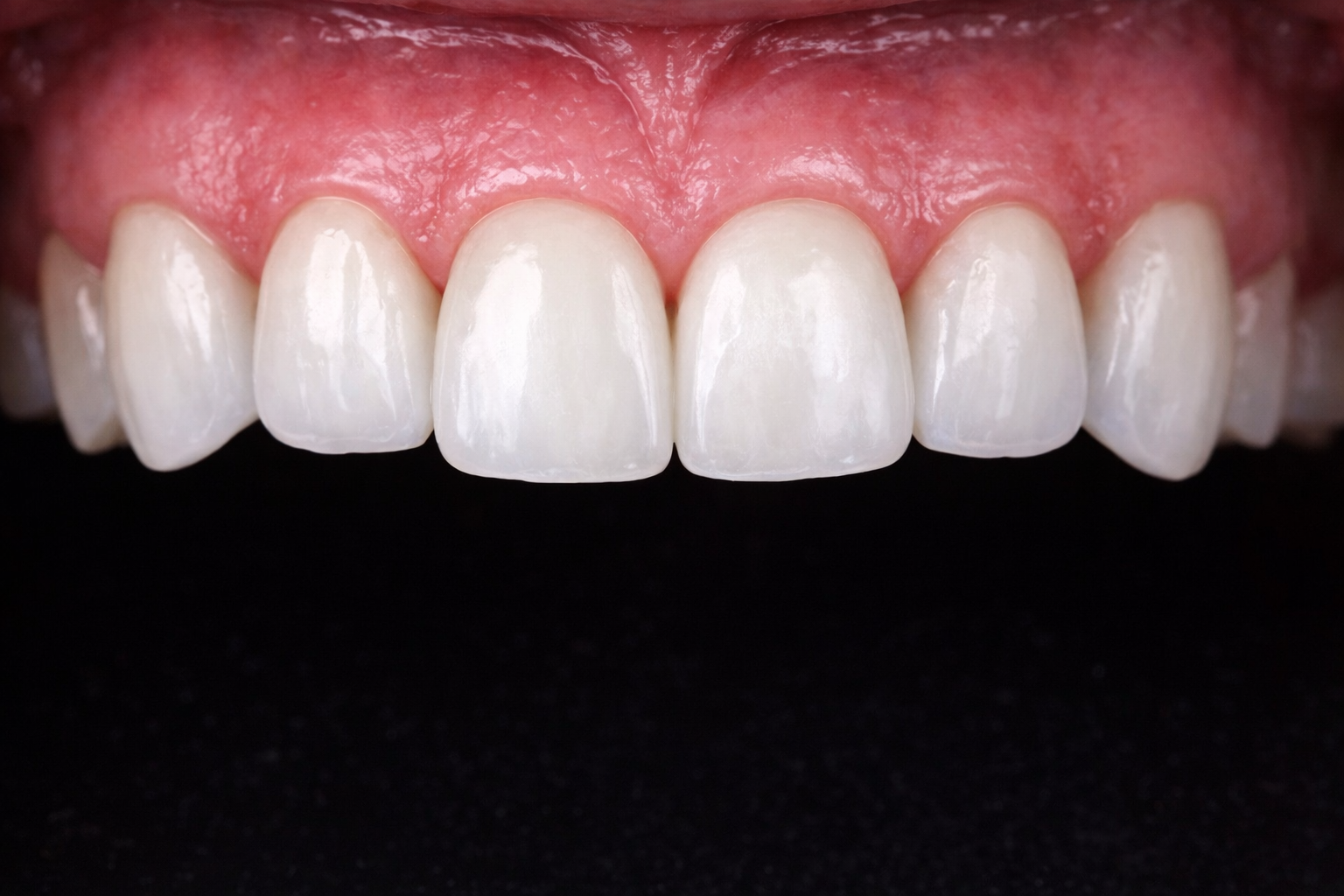 Close-up of upper front teeth with gums, showing white, clean teeth against a dark background.