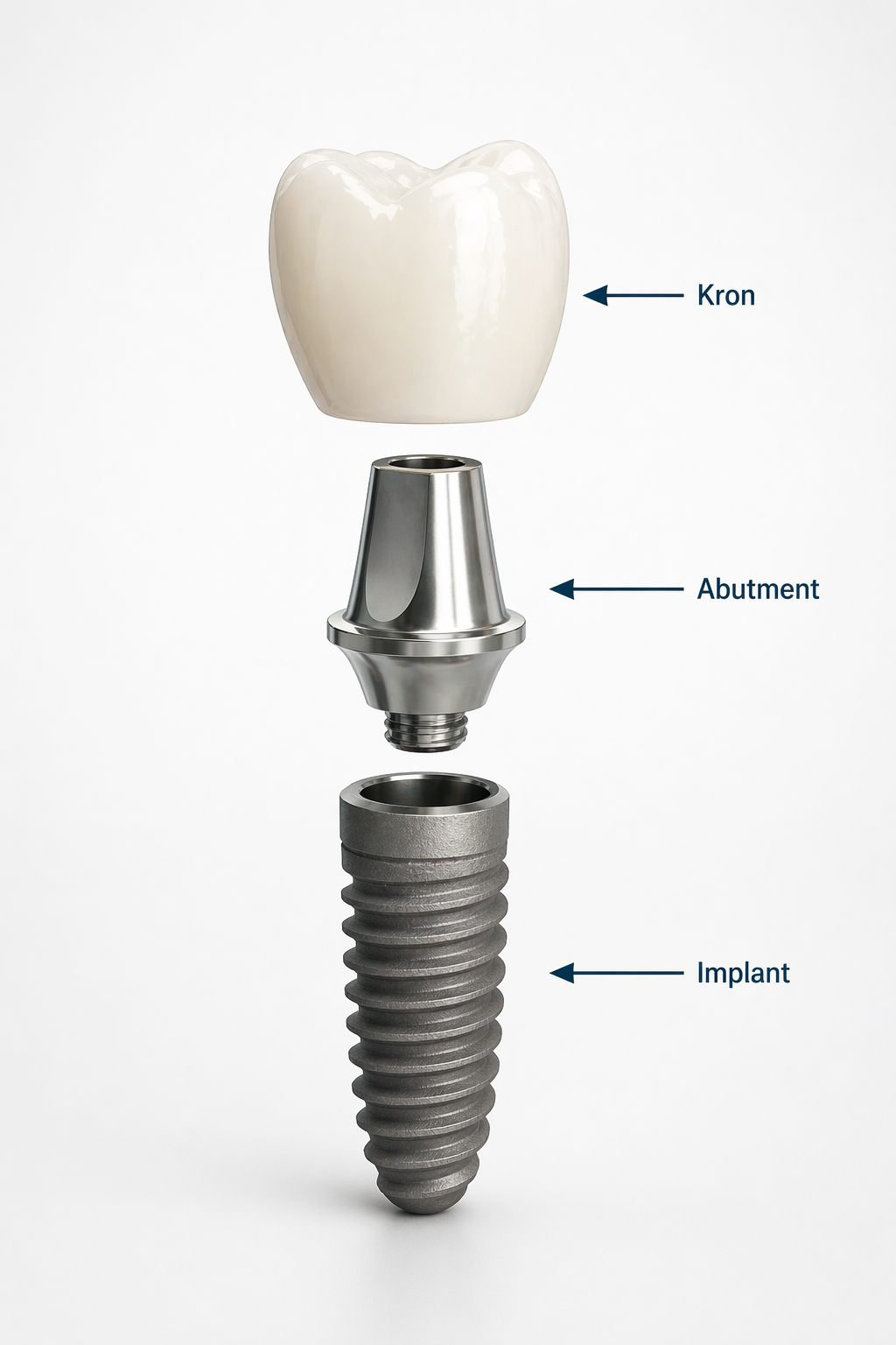 A diagram showing a dental implant system with three labeled parts: Crown, Abutment, and Implant.