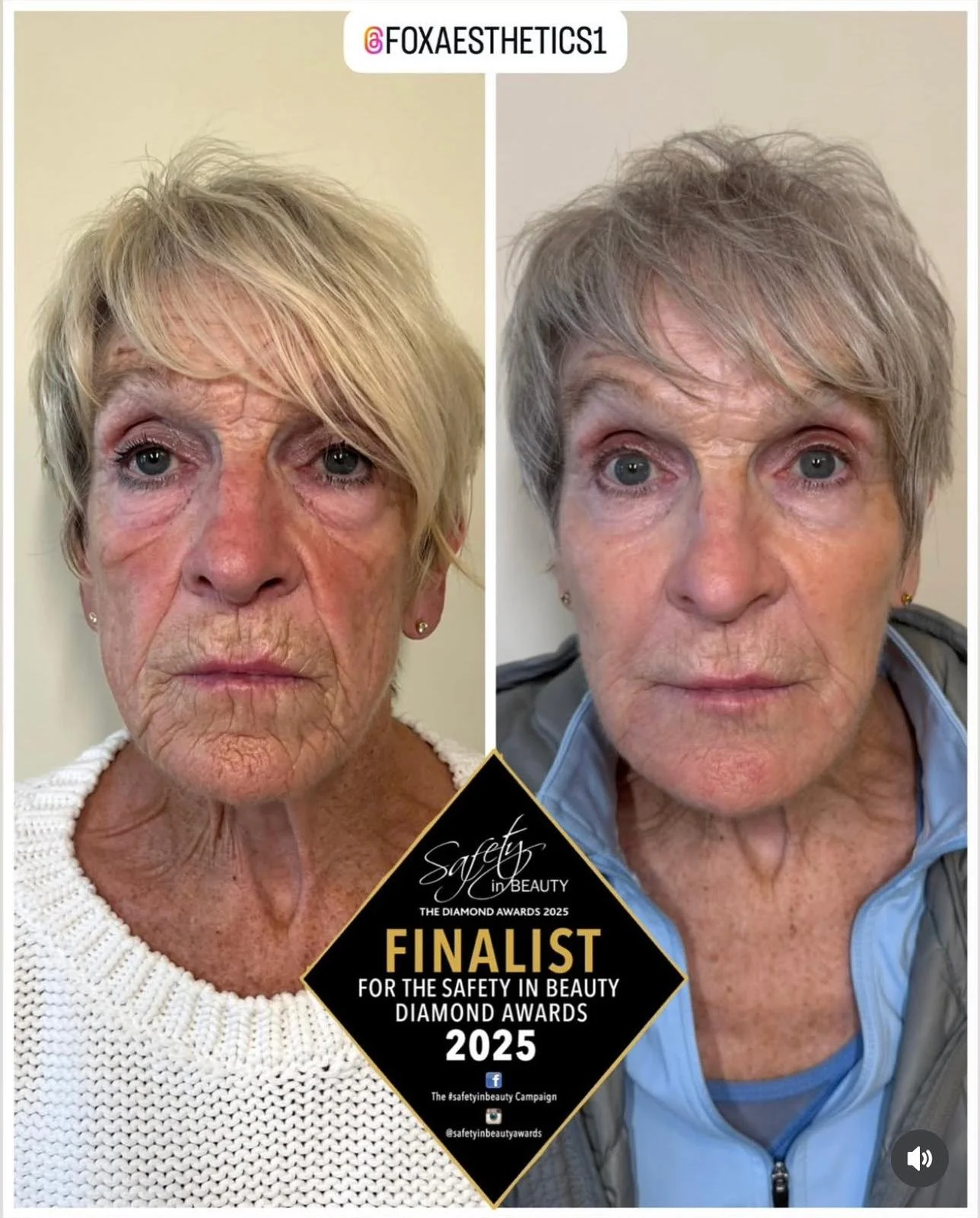 Client receiving aesthetic treatment