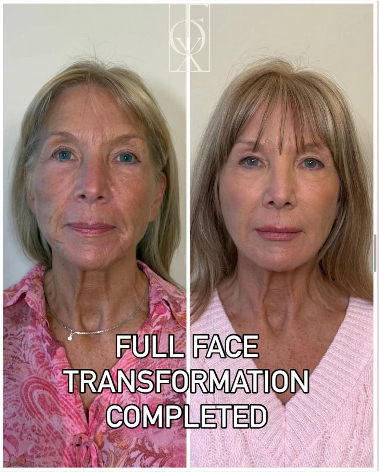Full-face rejuvenation treatment