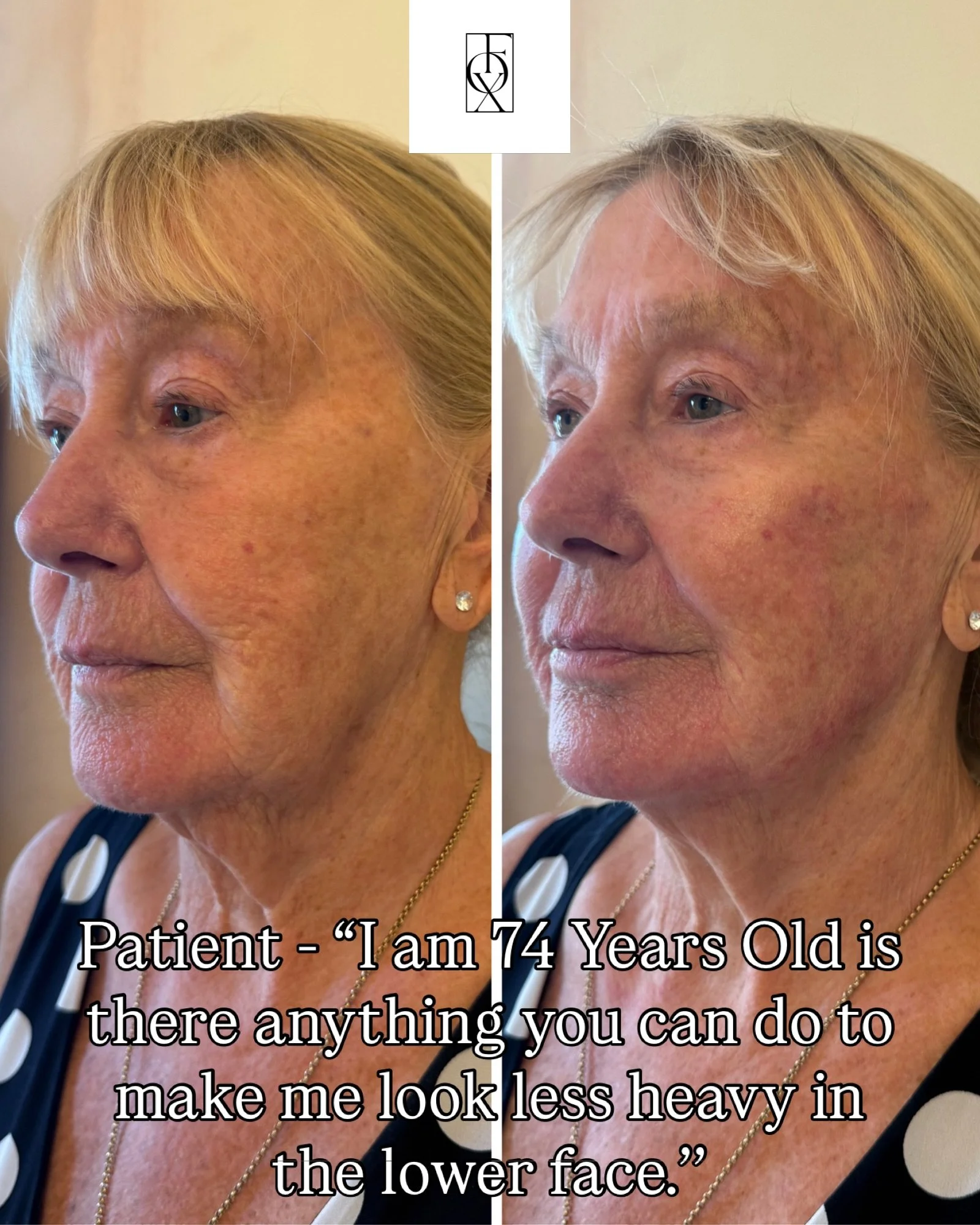 Dermal Fillers: 50s and Beyond&hellip;

Focuses on structural support, deep volume restoration in the cheeks and temples, and rebuilding facial scaffolding rather than chasing individual wrinkles.

Natural facial fat and bone resorption typically pro