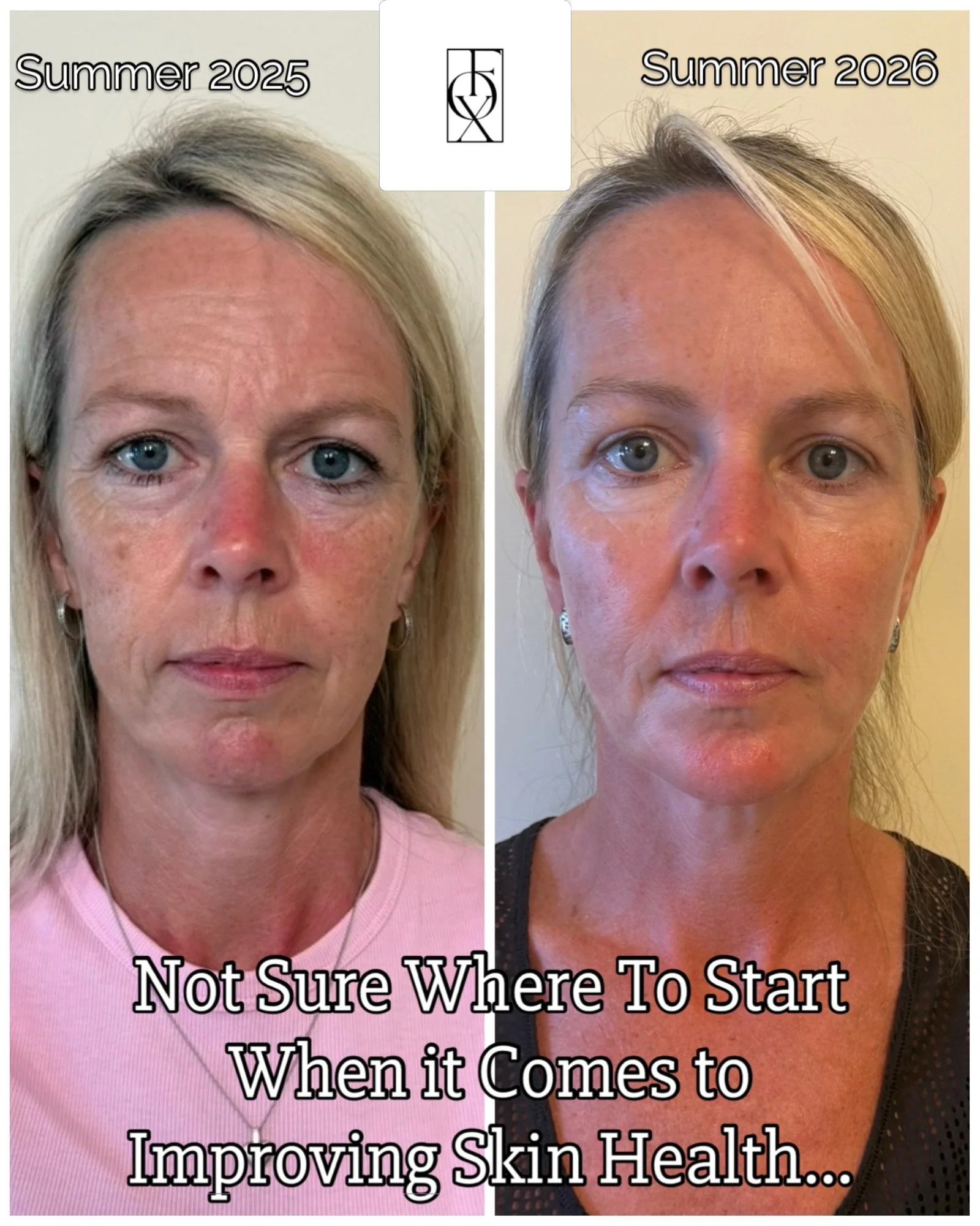 Patient - &lsquo;&rsquo; I Have Had So Many Compliments&rsquo;&rsquo;

This is what CONSISTENCY looks like. These images are almost a year apart. 

This patient has chipped away at her treatment plan which has included:

💫 Dermal fillers to the uppe
