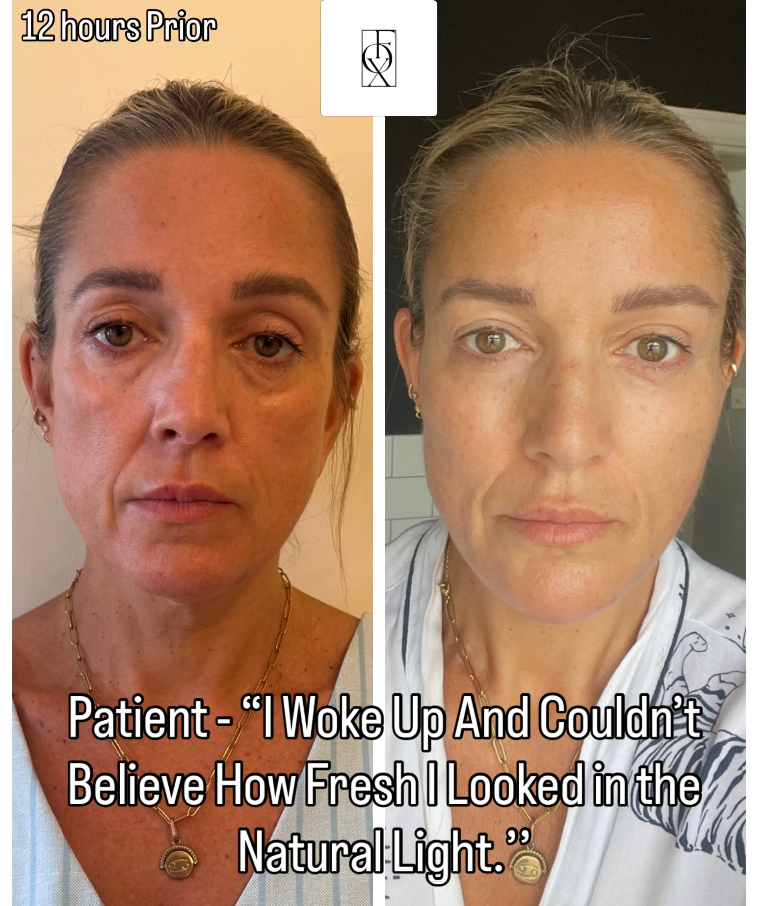 Yes 🙌 to looking REFRESHED&hellip;

What a fabulous message I received this morning from this gorgeous patient. 

The image on the right was her waking up this morning following 8mls of dermal fillers. 

The image even shocked 😳 me! She looks absol
