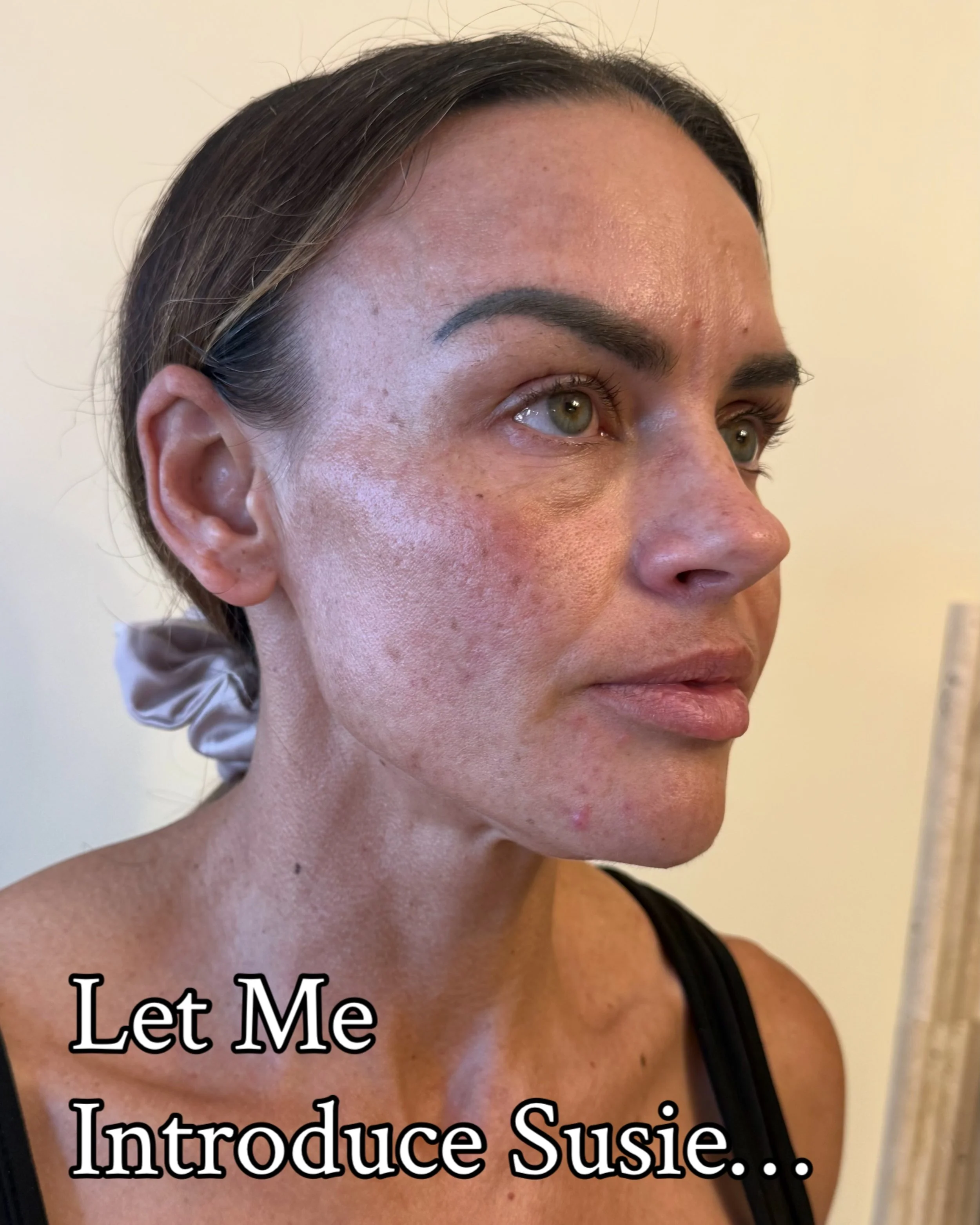 Watch this Skin Transformation Unfold&hellip;

This beautiful patient has VERY kindly agreed to show us her Skin Journey over the next few months. 

This Journey won&rsquo;t be easy for Susie in the first few weeks. It takes DEDICATION.

Susie is det