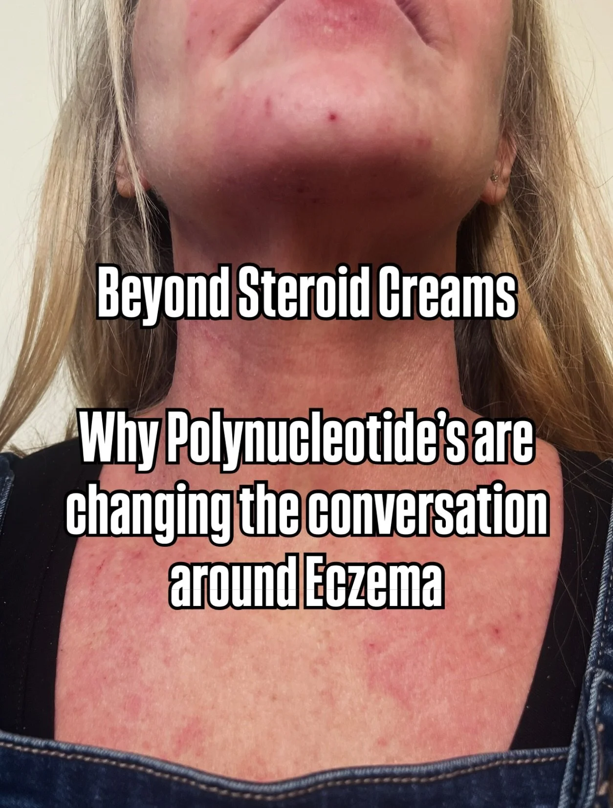 ✨ Say goodbye to flare-ups and hello to cellular healing! ✨

If you&rsquo;re dealing with eczema, you know the cycle all too well: the intense itch, the stubborn redness, and the constant battle against inflammation. 

Conventional creams often just 