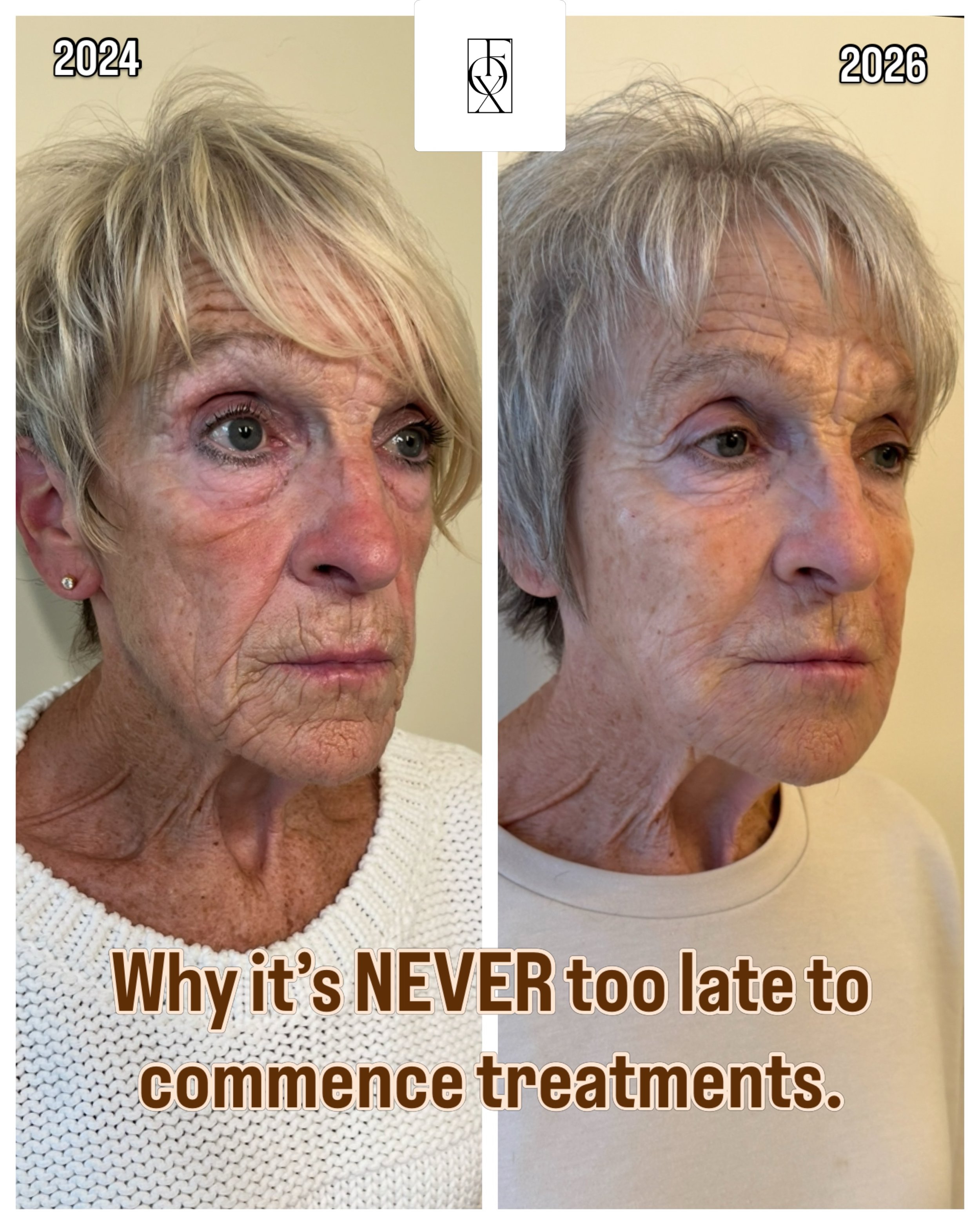 Age is just a number, and your SKIN doesn&rsquo;t care what year is on your birth certificate.

It is a common myth that you have to start aesthetic treatments in your 20s or 30s to see results. 

The truth is, your skin is incredibly resilient, and 