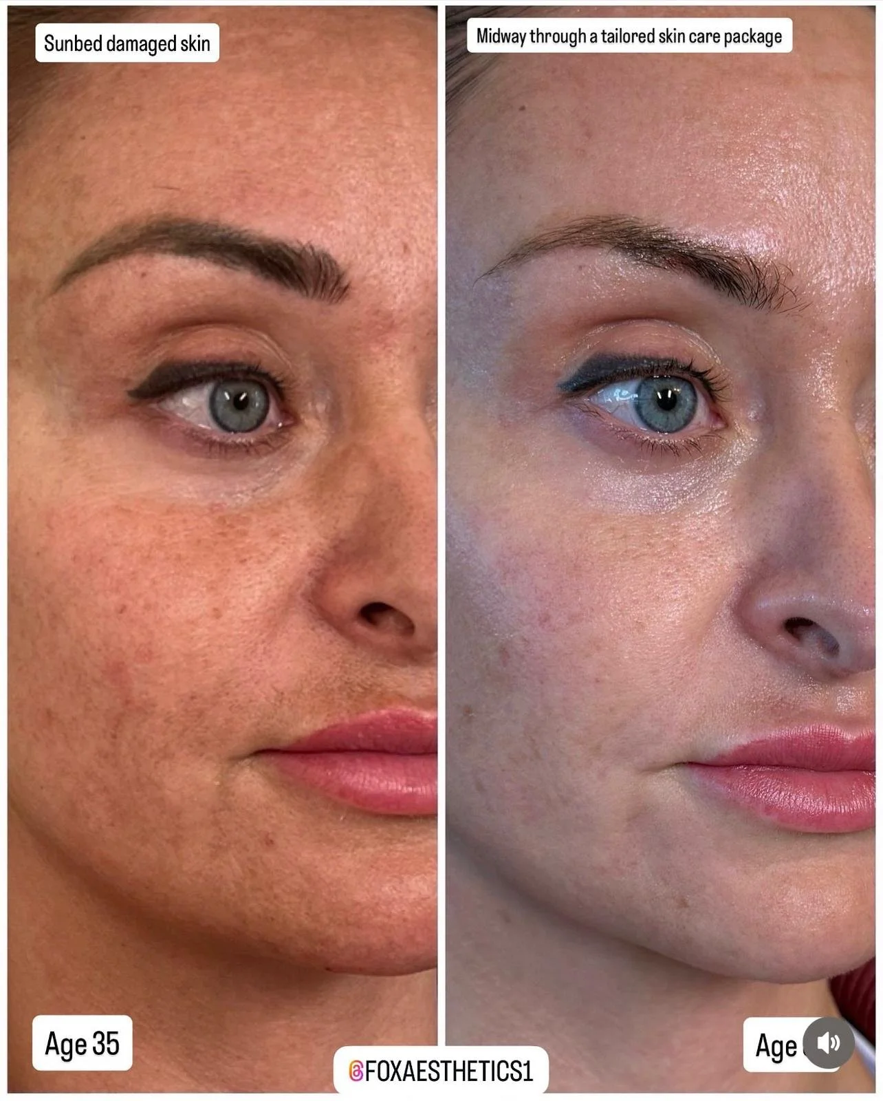 Non-surgical facial enhancement