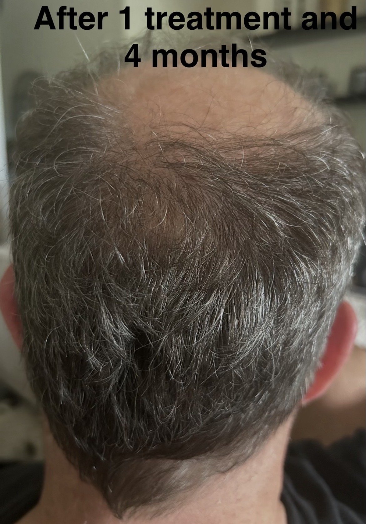 Jay posterior after.jpg