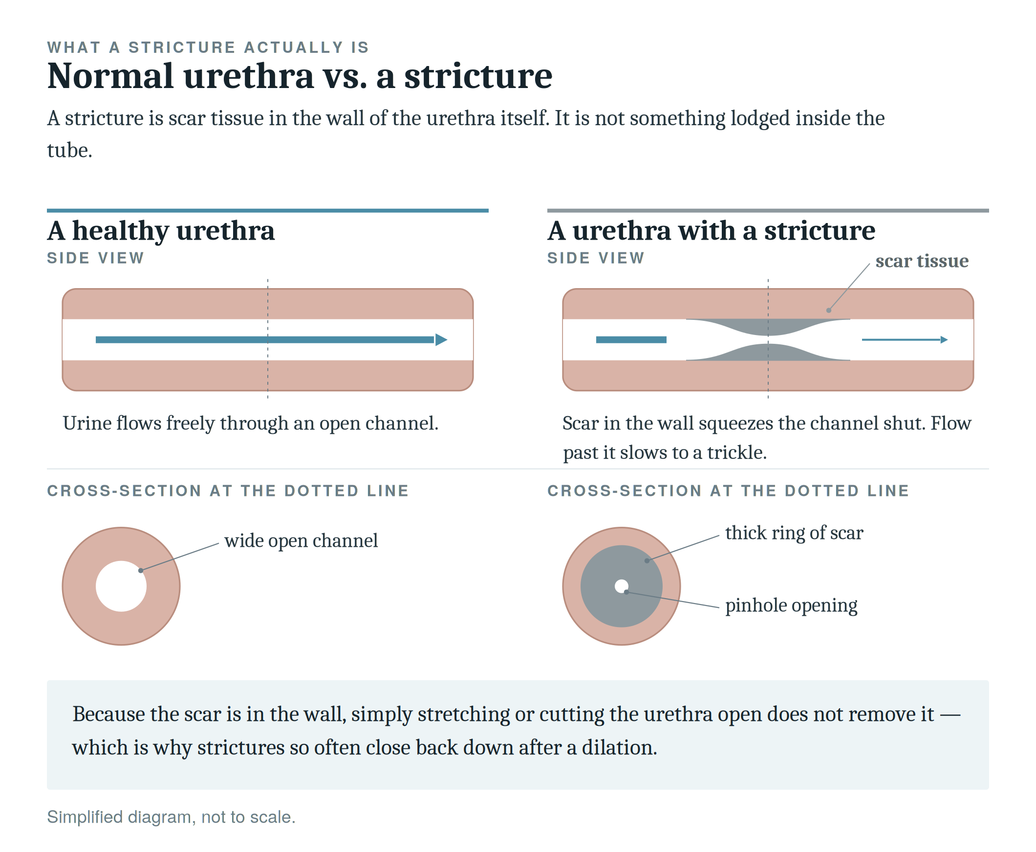 Diagram comparing a healthy urethra and a urethra with a stricture, showing cross-sections at the dotted line. The healthy urethra has a wide open channel for urine flow, while the urethra with a stricture has scar tissue causing a narrow passage and pinhole opening, leading to flow restriction.