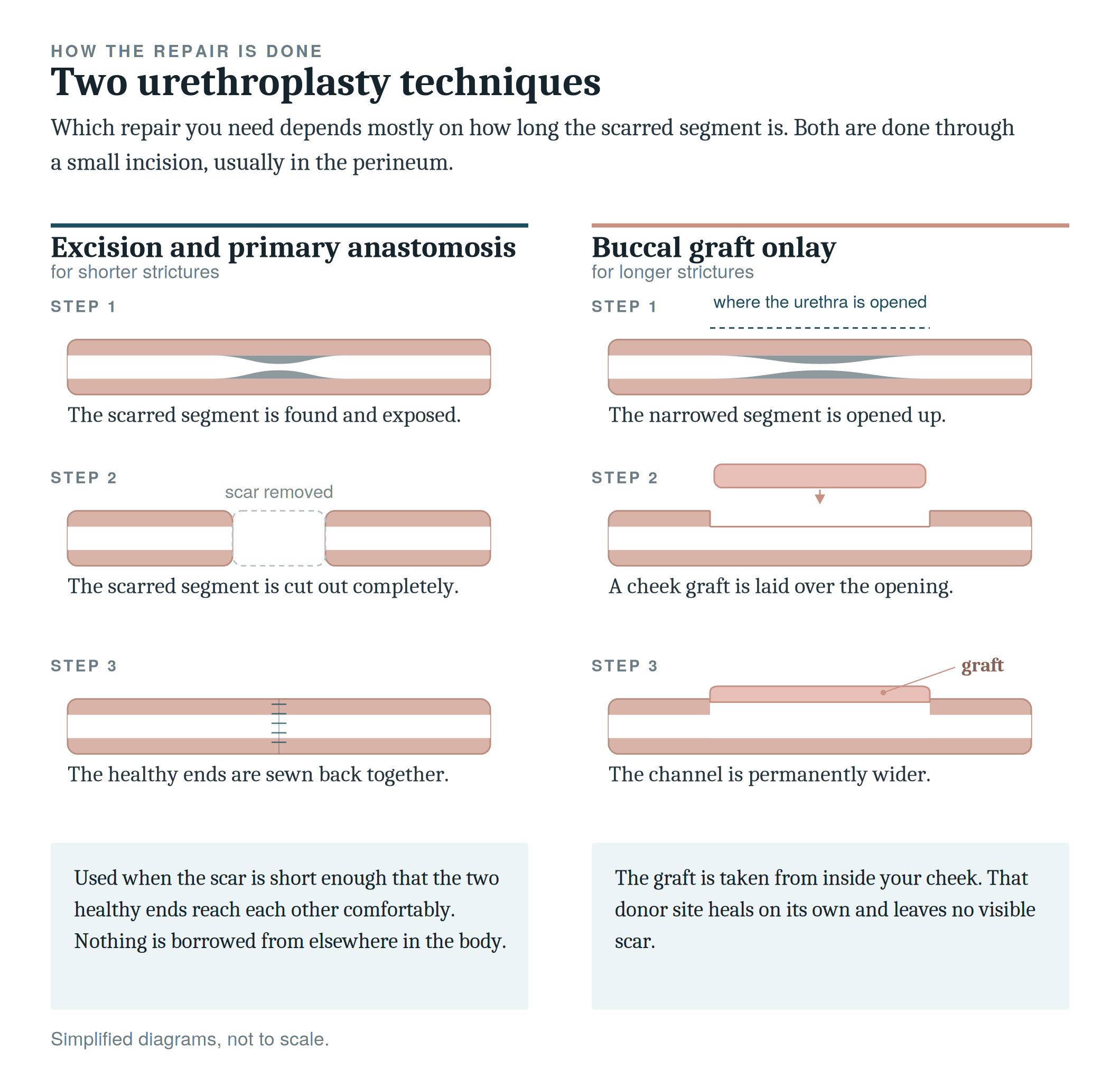 Infographic showing two urethroplasty techniques, excision and primary anastomosis and buccal graft onlay, with steps and illustrations of surgical procedures.