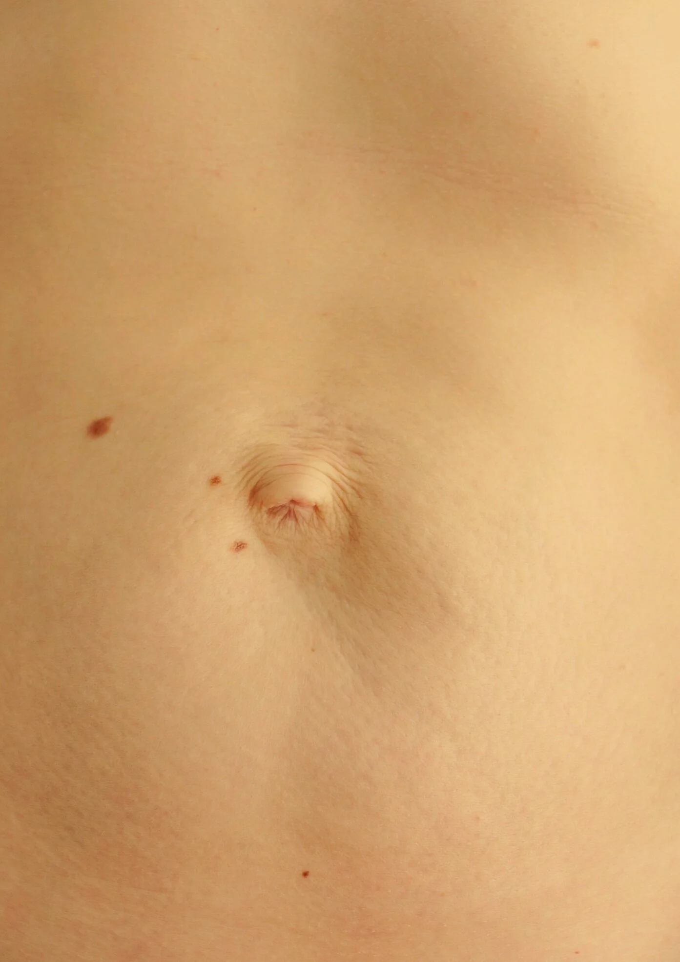 Diastasis
