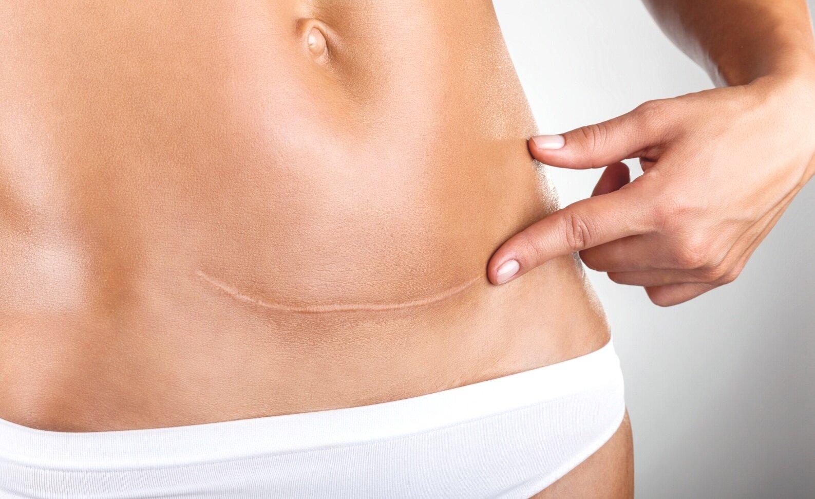 C section check up postpartum perinatal physio den haag the hague pelvic physiotherapy bekkenfysiotherapie