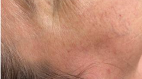 Redness, rosacea and vascular correction using DPC technology  at Skin Vault Spa