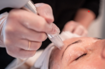 Microneedling-thornhill for collagen stimulation and skin texture improvement at Skin Vault Spa