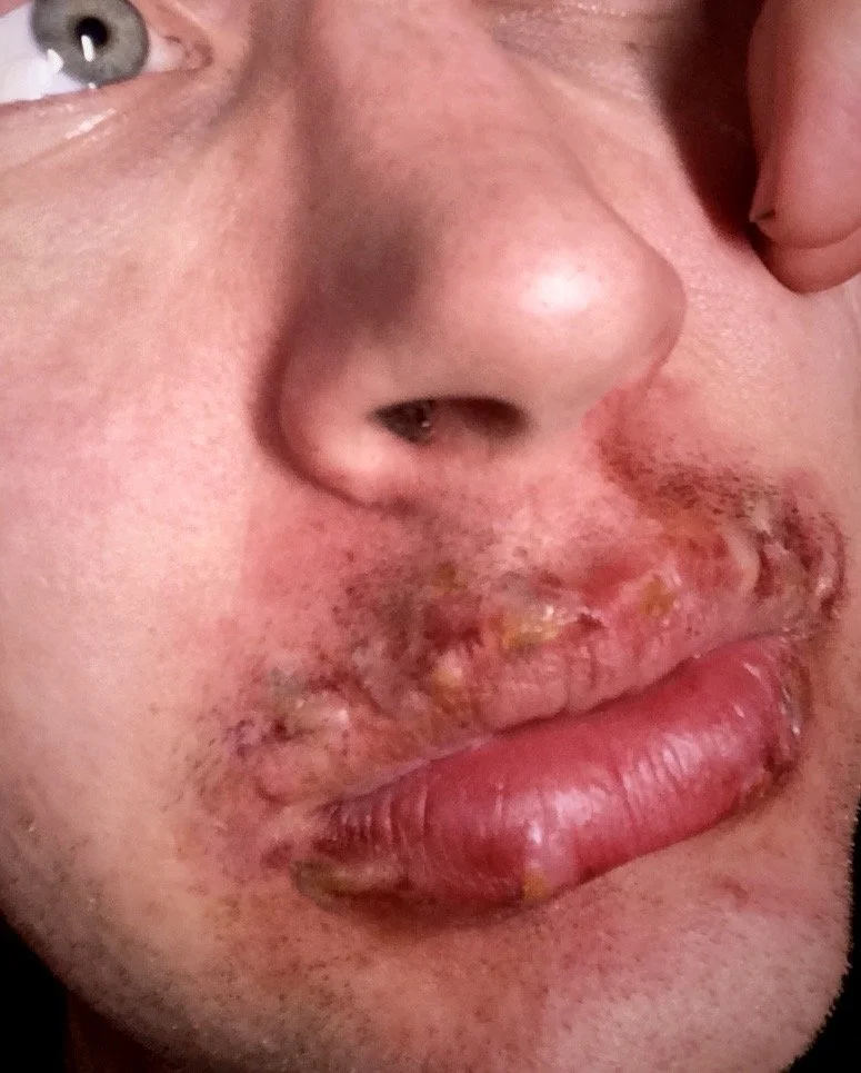 Close-up of a person's face with facial injuries, including swollen lips with crusted and dried blood, a cut above the upper lip, and visible skin irritation.