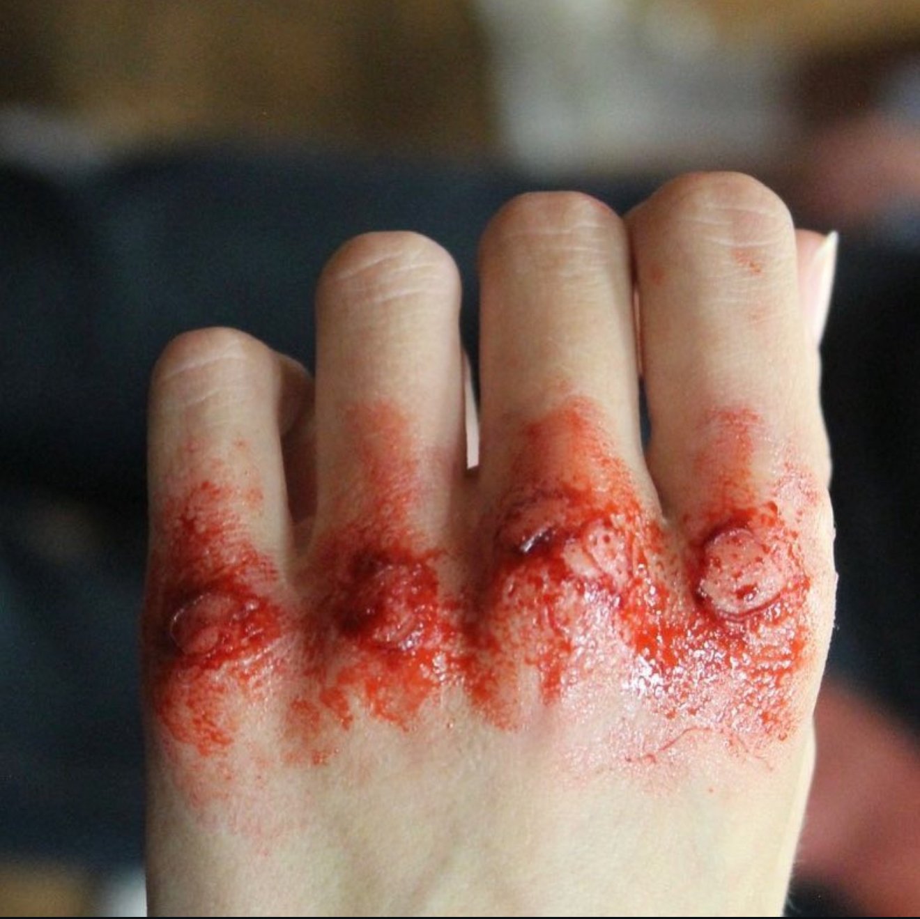 Close-up of a hand with red, bloody, and blistered skin, likely from an injury or burn.