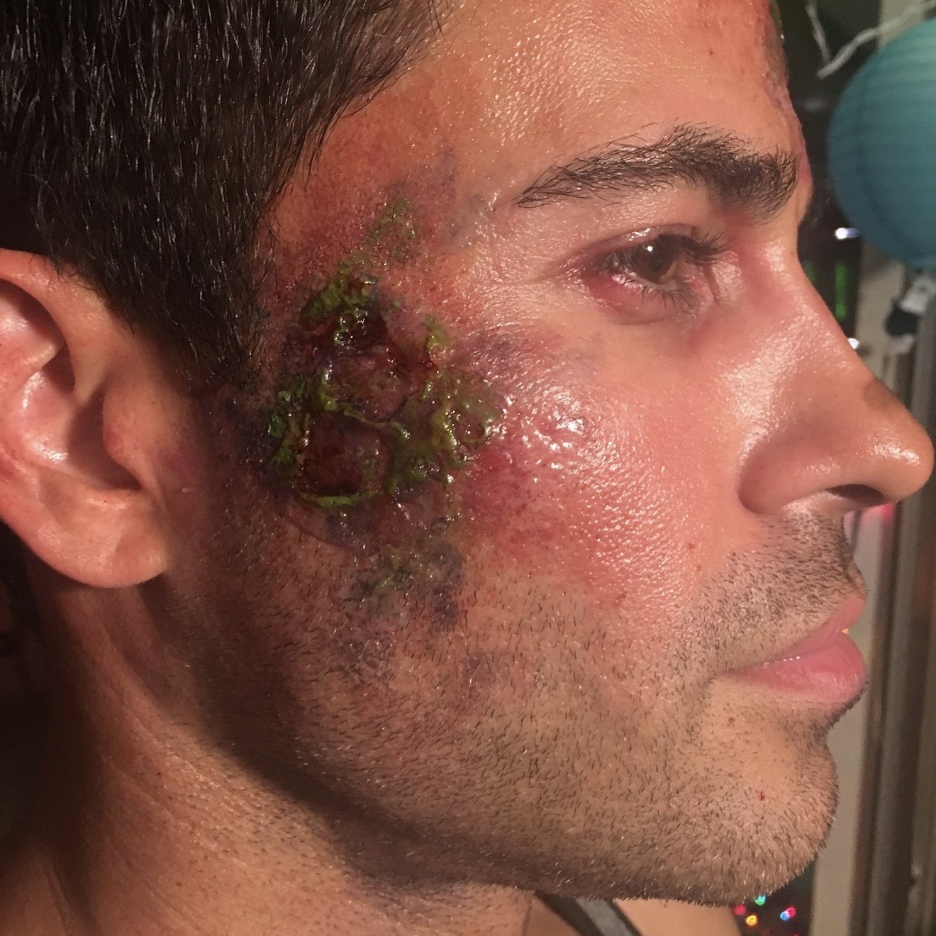 A man with facial injuries, including redness, swelling, and what appears to be infected or ulcerated skin on his cheek near his ear.