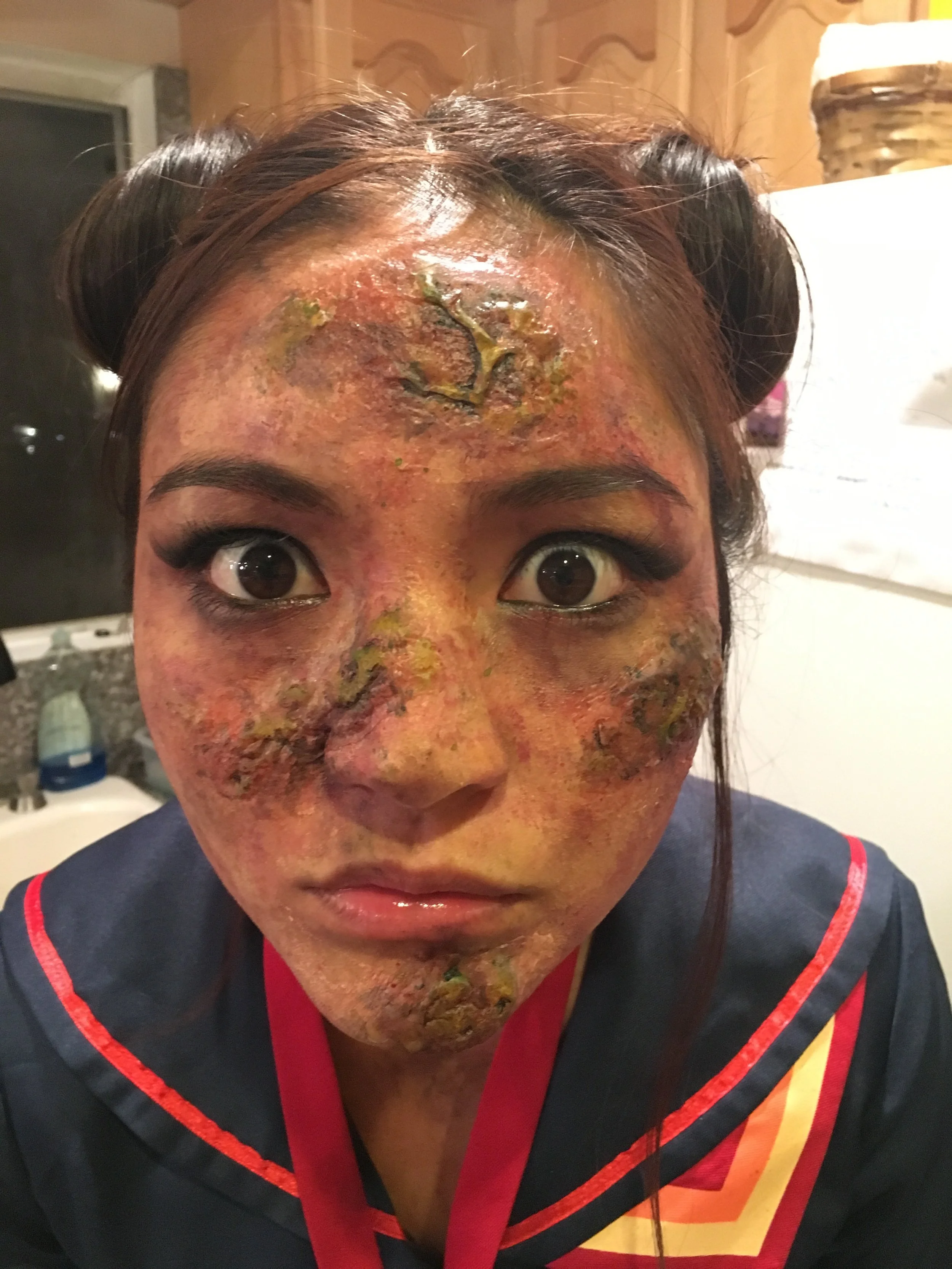 Person with severe facial burns and skin damage, wearing a navy blue and red uniform, indoors.