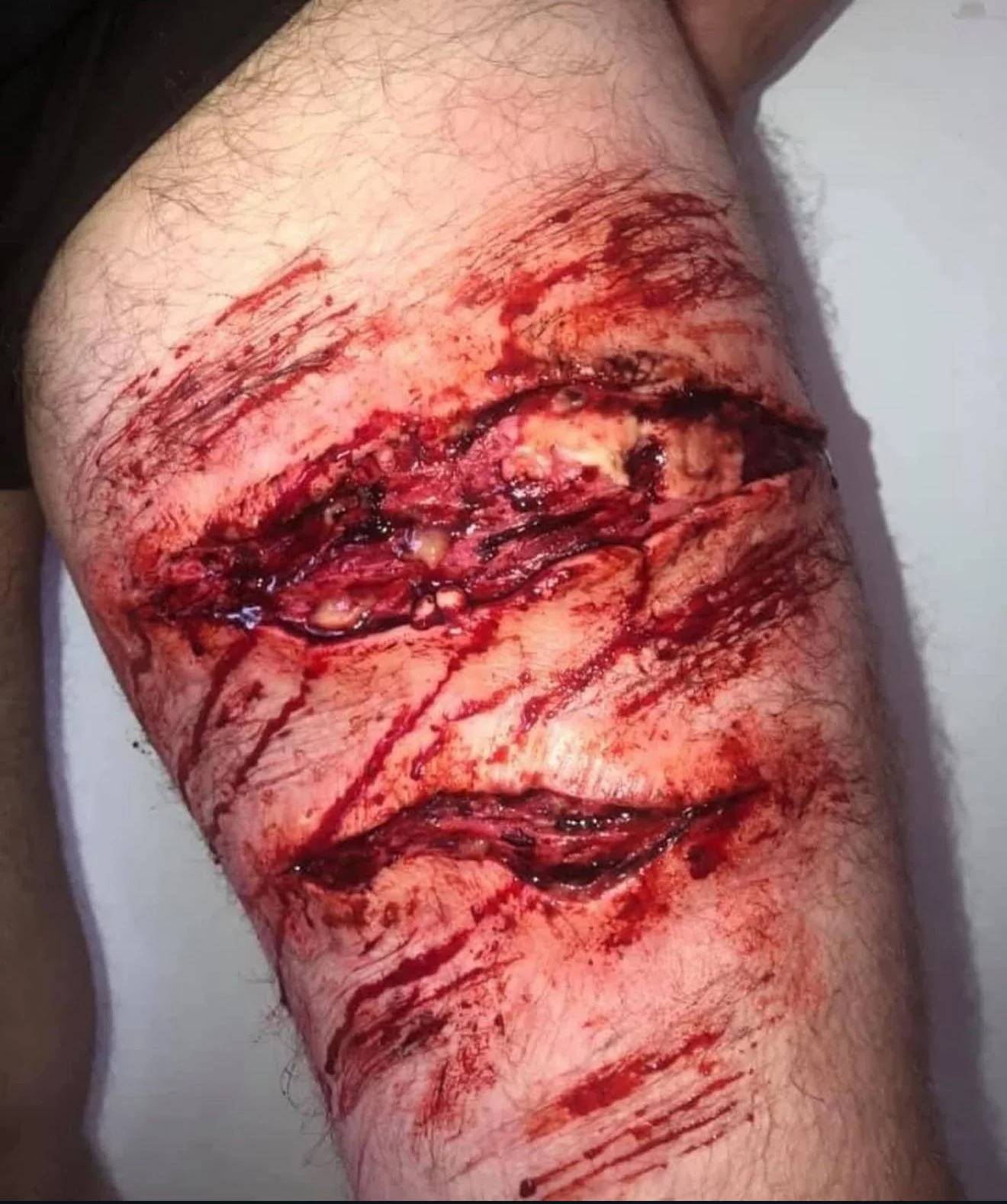 Close-up of a deep, bloody cut or wound on a person's leg, with visible tissue, blood, and bruising.
