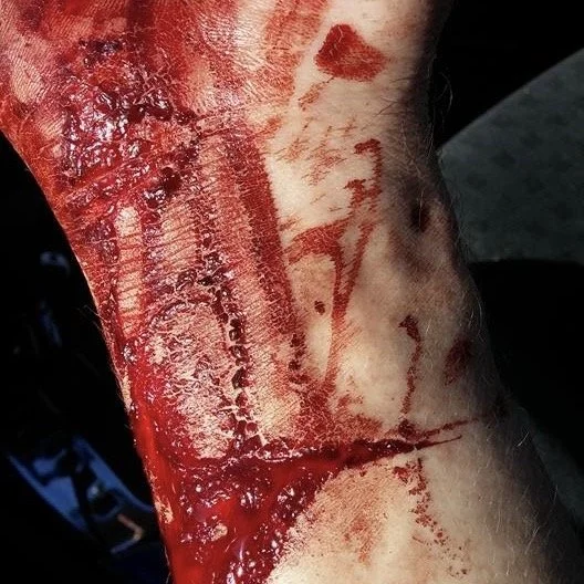 Close-up of a person's arm with fresh, severe cuts and blood.