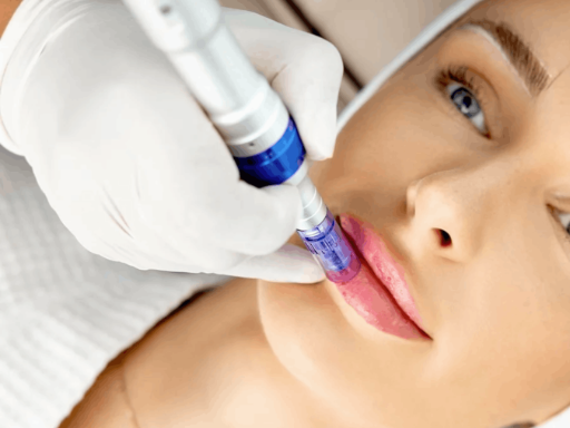 vitalis-nanoneedling-lip-infusion.webp