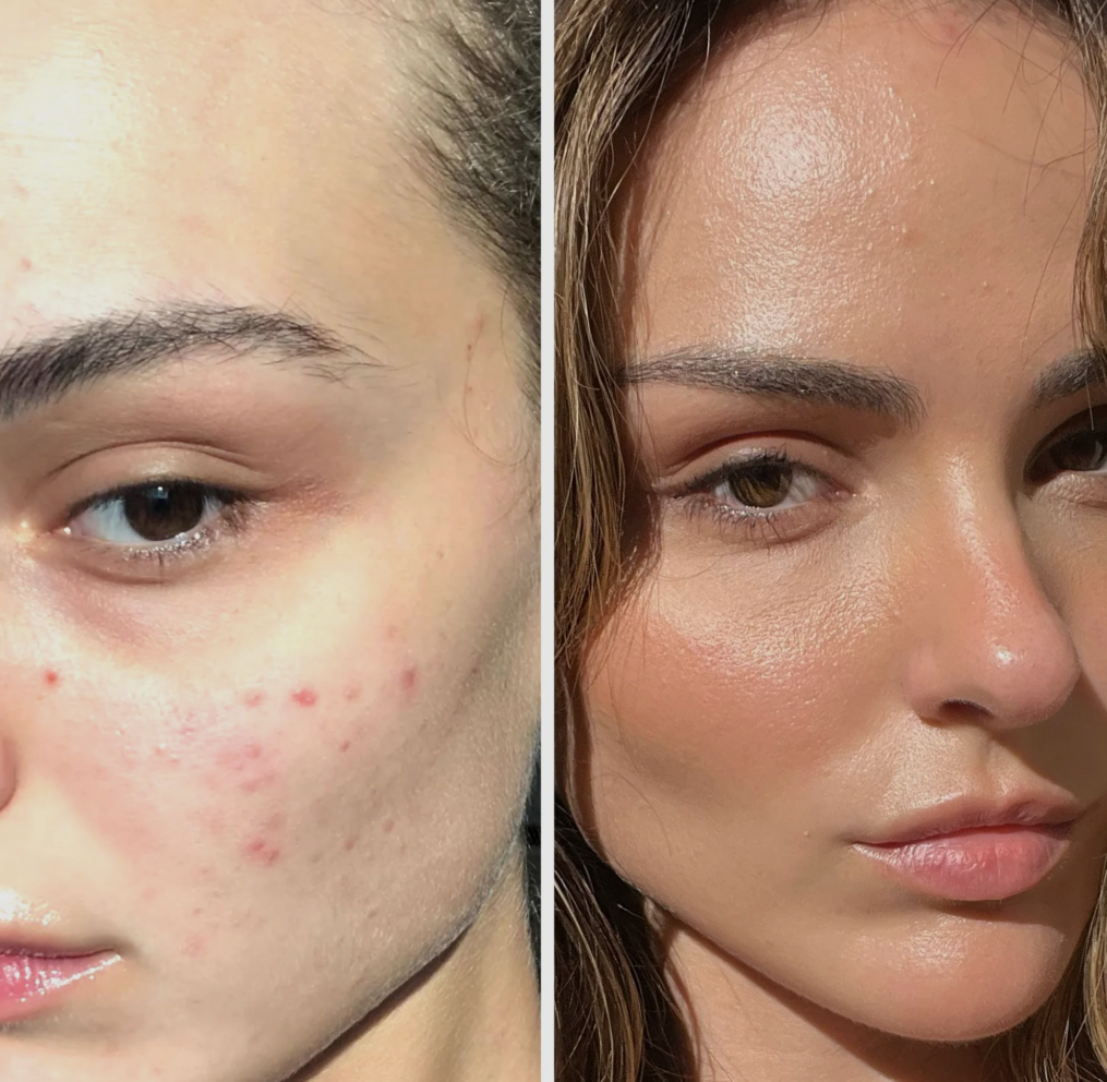 VITALIS Clear Skin Acne Program