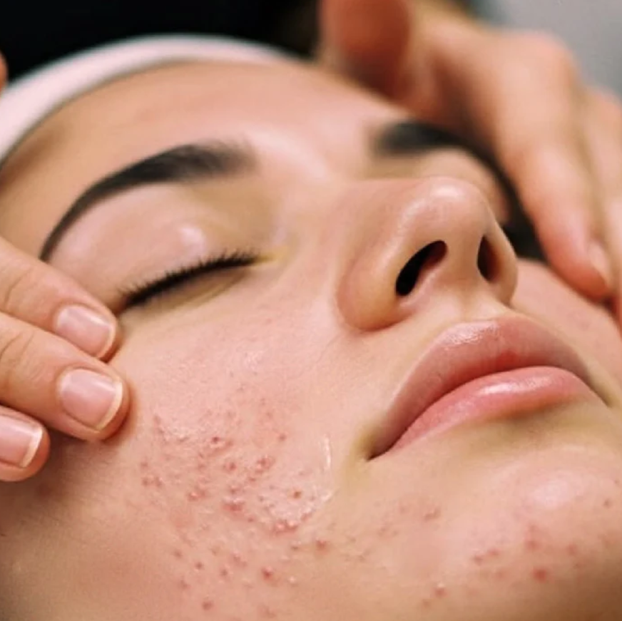 VITALIS Clear Skin Acne Facial
