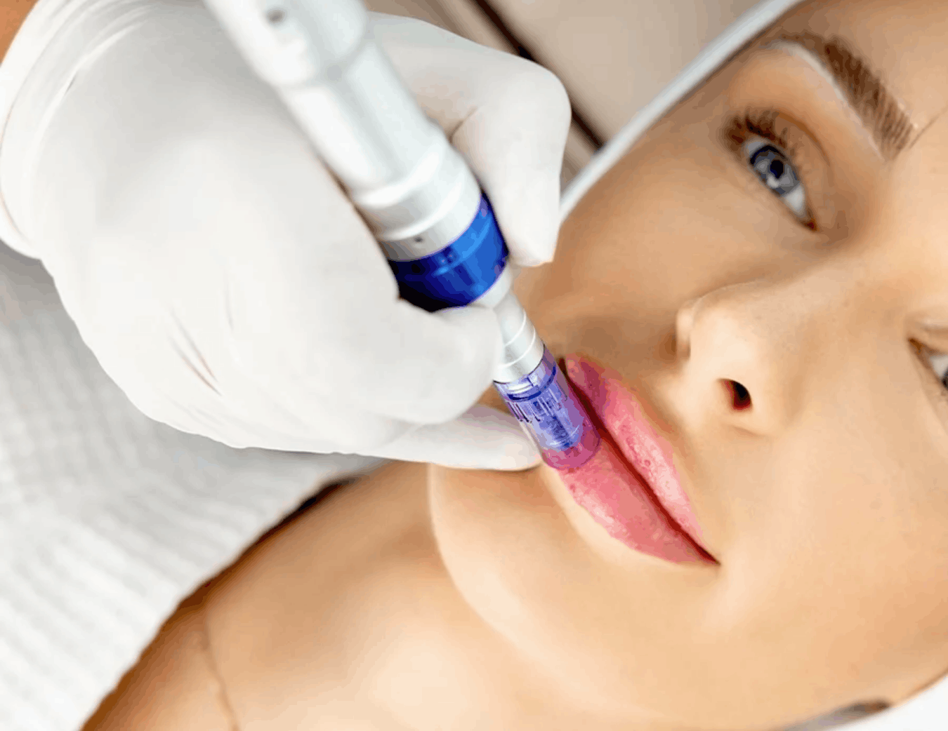 VITALIS Lip Infusion – Nano-Needling Lip Treatment