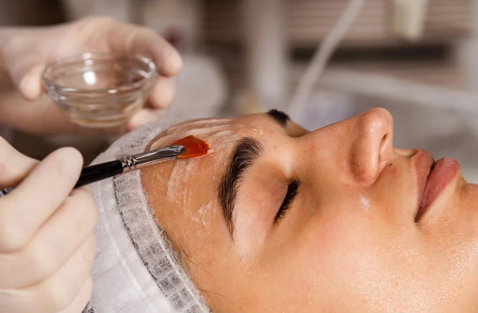 Chemical Peels for Melasma: Gentle Acids, Strong Results