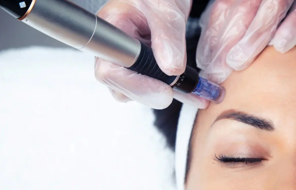 Microneedling Near Boston: What to Expect Before, During &amp; After(From your esthetician team at Vitalis Luxe Spa in Medford, MA)