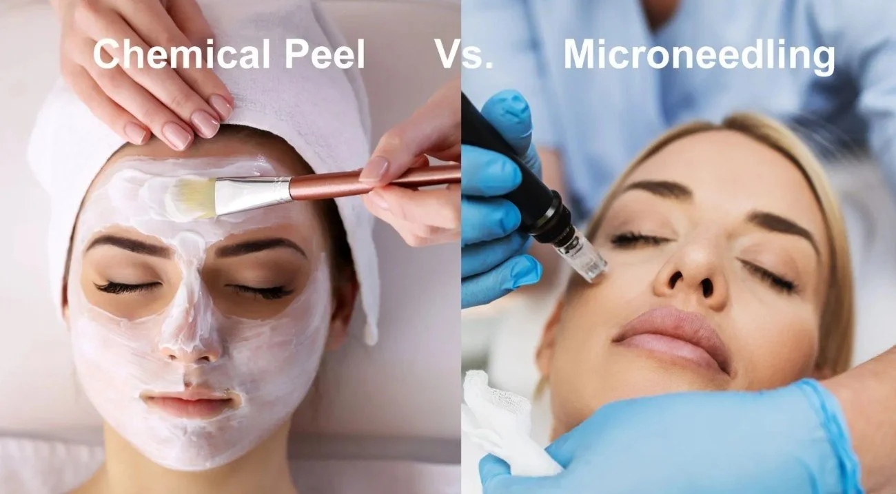 Microneedling vs. Chemical Peels for Post Winter Skin Repair