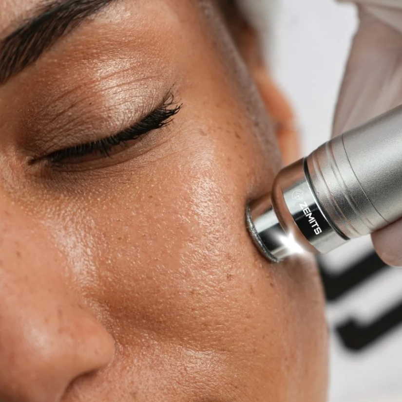 A woman receiving professional microdermabrasion as a skincare specialist gently resurfaces the skin to remove dead skin cells, smooth texture, reduce the appearance of fine lines and acne scars, and reveal a brighter, more even, youthful-looking com