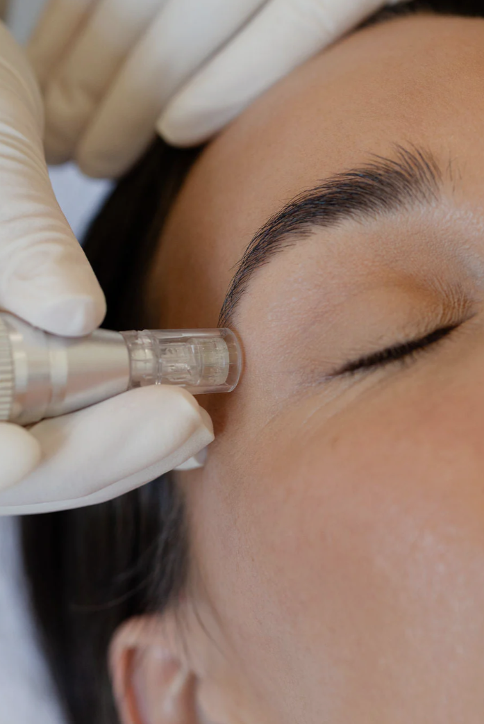 VITALIS Collagen Renewal Microneedling Series