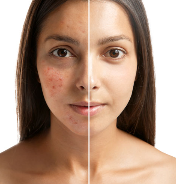Side-by-side comparison of a woman with acne on the left and clear skin on the right.