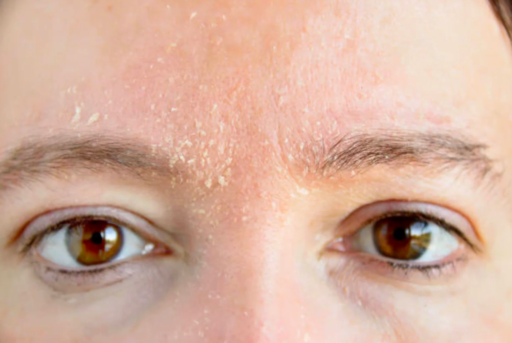 Close-up of a person's face focusing on the forehead area with dry, flaky skin and visible peeling patches.