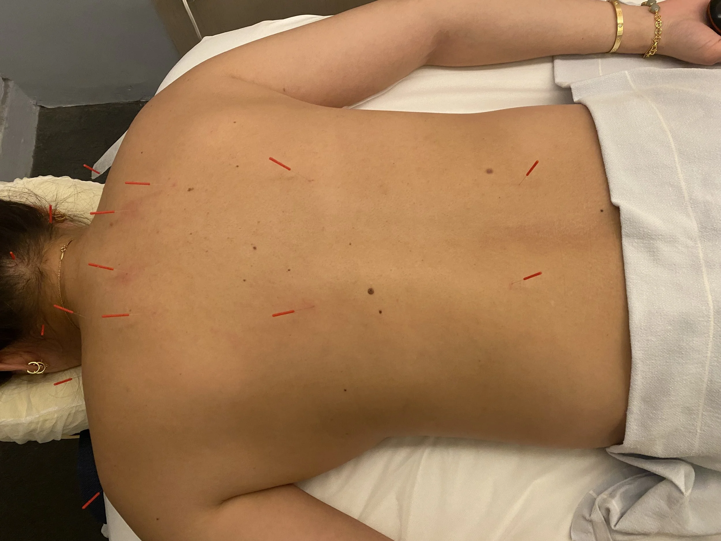 Acupuncture - Continuing Care
