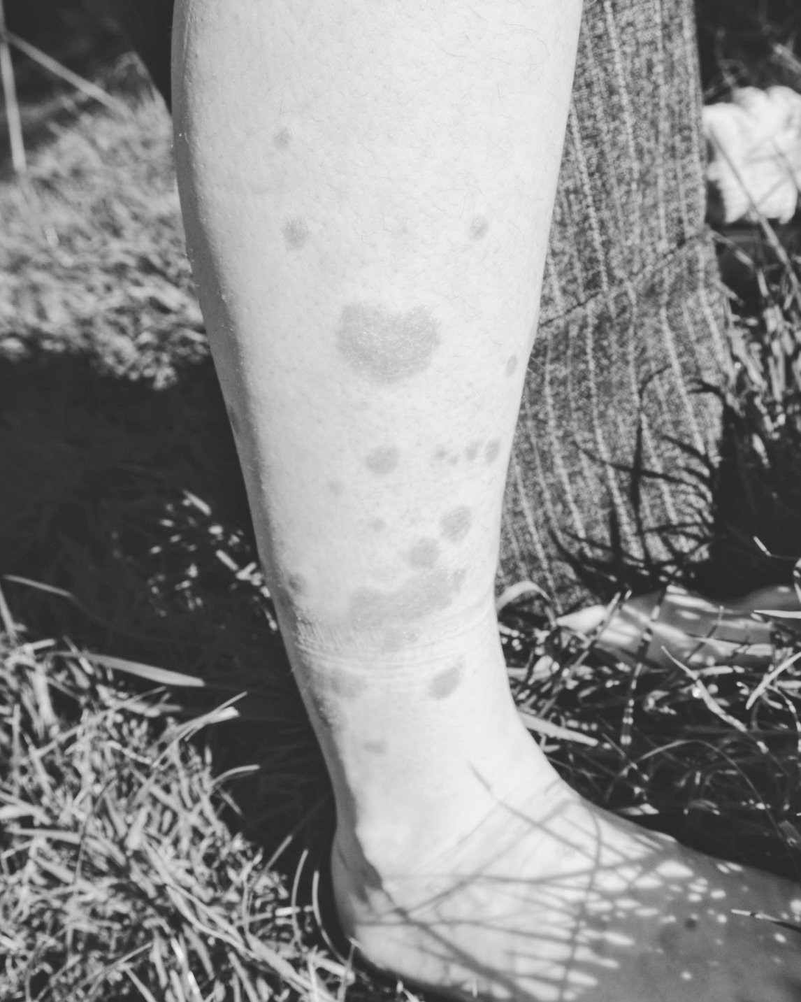 A story of psoriasis and acceptance