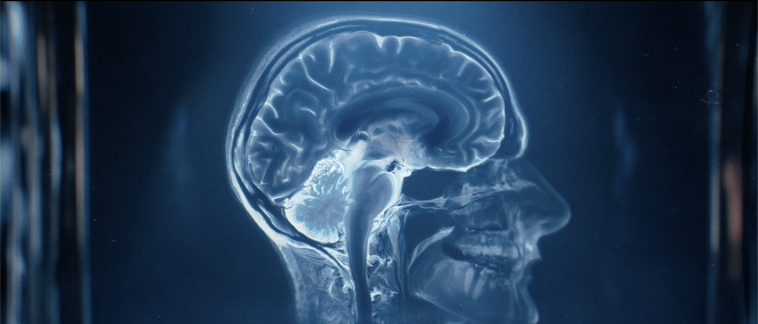 For the first time, scientist were able to look inside the brain during extended periods of hyperventialion..png