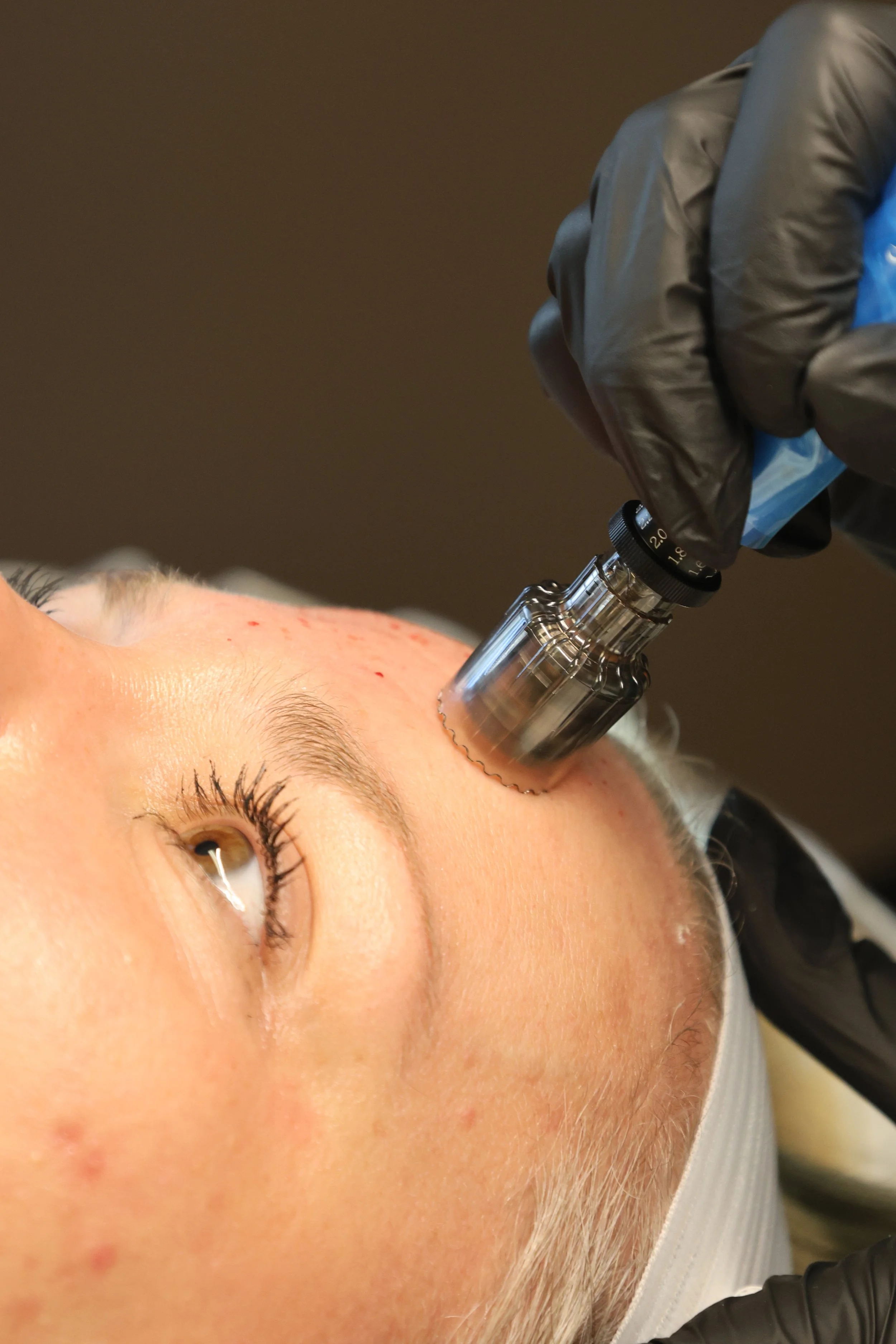 Microneedling treatment promoting collagen production and healthier-looking skin.