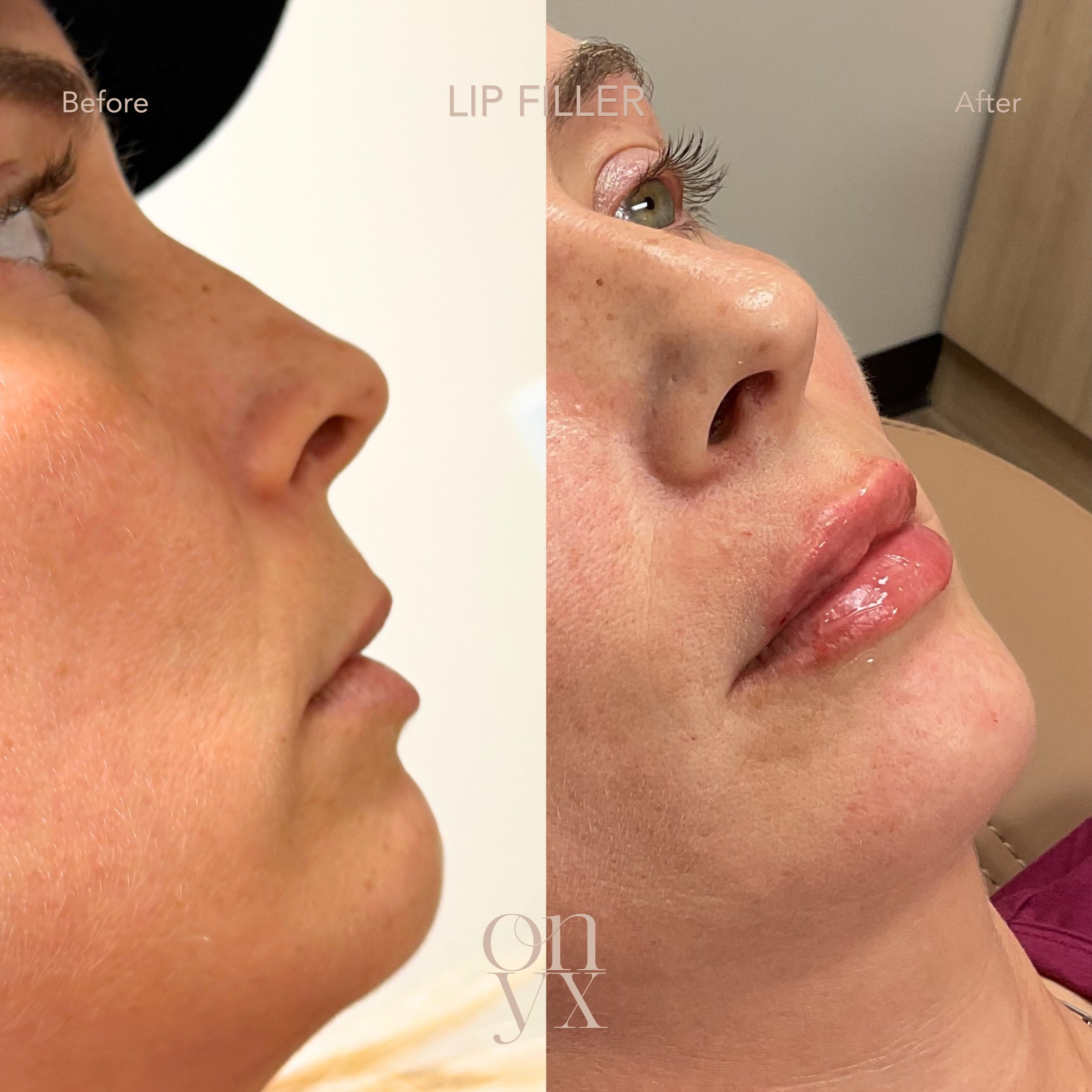 Before ➡️ After ✨

Enhancing what&rsquo;s already there with results that feel balanced, refreshed, and natural.

If you&rsquo;re interested in seeing results on yourself, schedule your consultation at the link in our bio.

#OnyxAesthetics #Statesvil