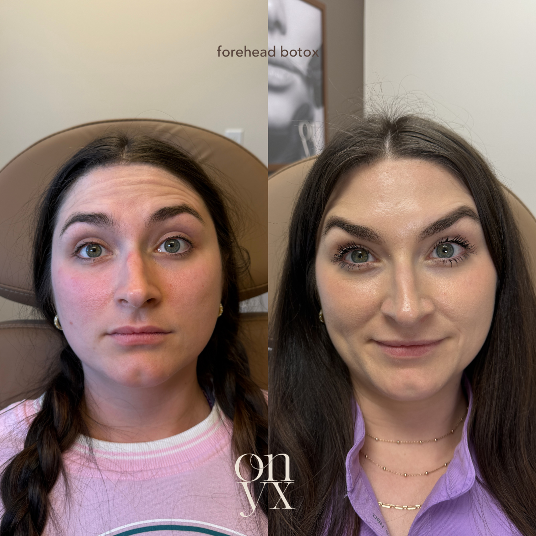 Botox and Dysport treatments for natural-looking wrinkle reduction in Statesville, NC.