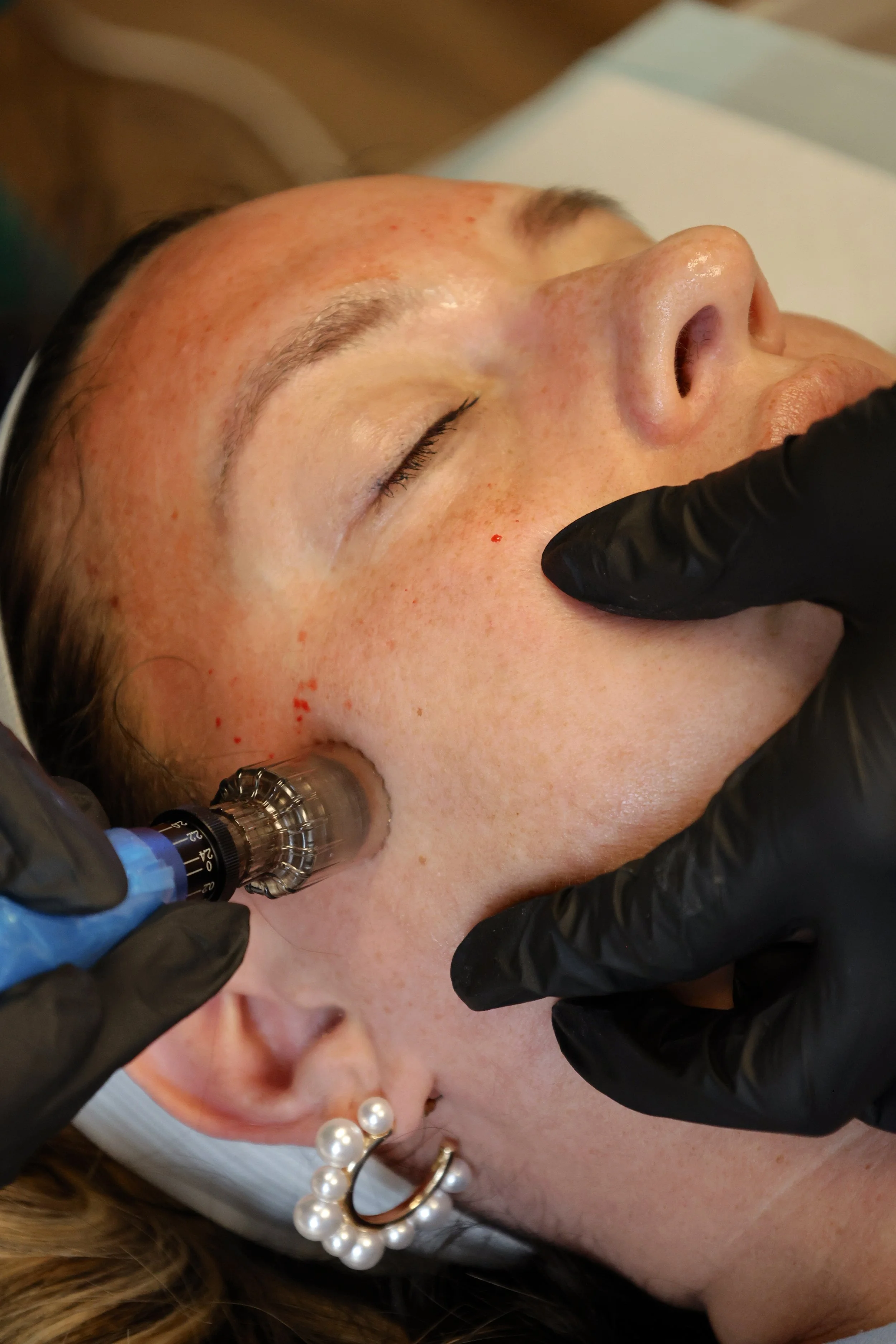 Microneedling treatment stimulating collagen for smoother, healthier-looking skin.