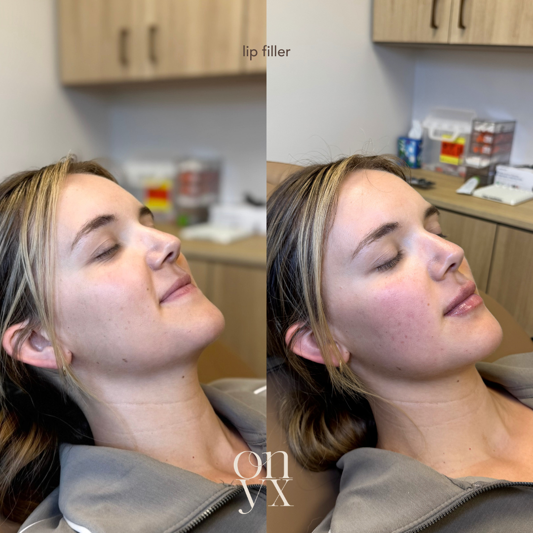 Dermal fillers restoring facial volume and enhancing natural facial contours.
