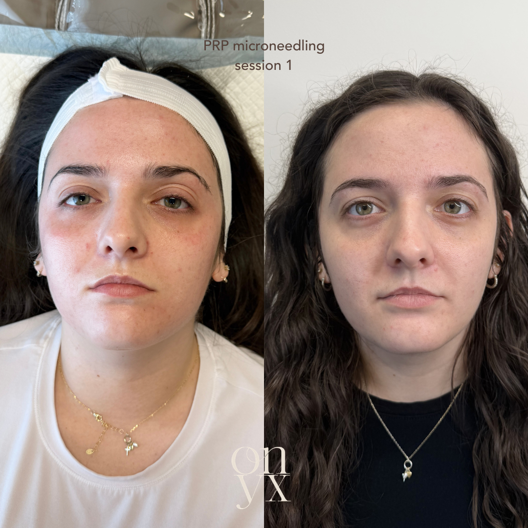 PRP Consultation at Onyx Aesthetics in Statesville, NC.