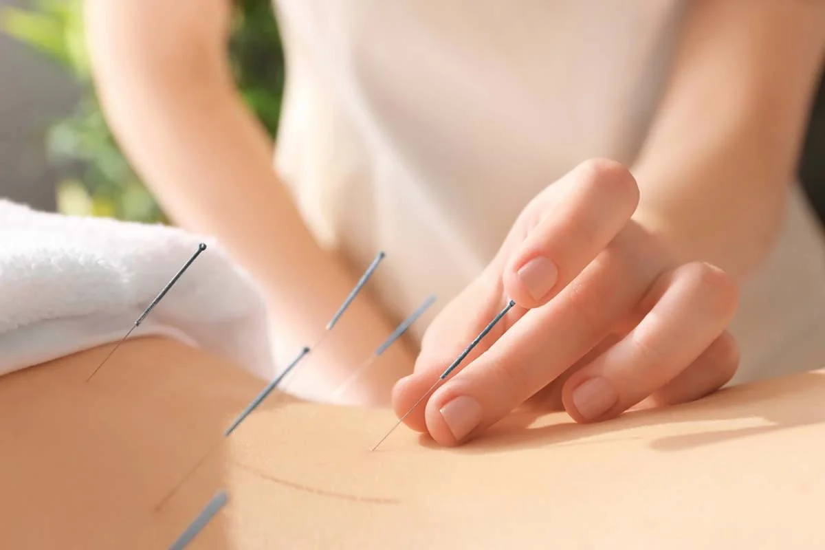 A person receiving acupuncture treatment, with multiple acupuncture needles inserted into their skin.