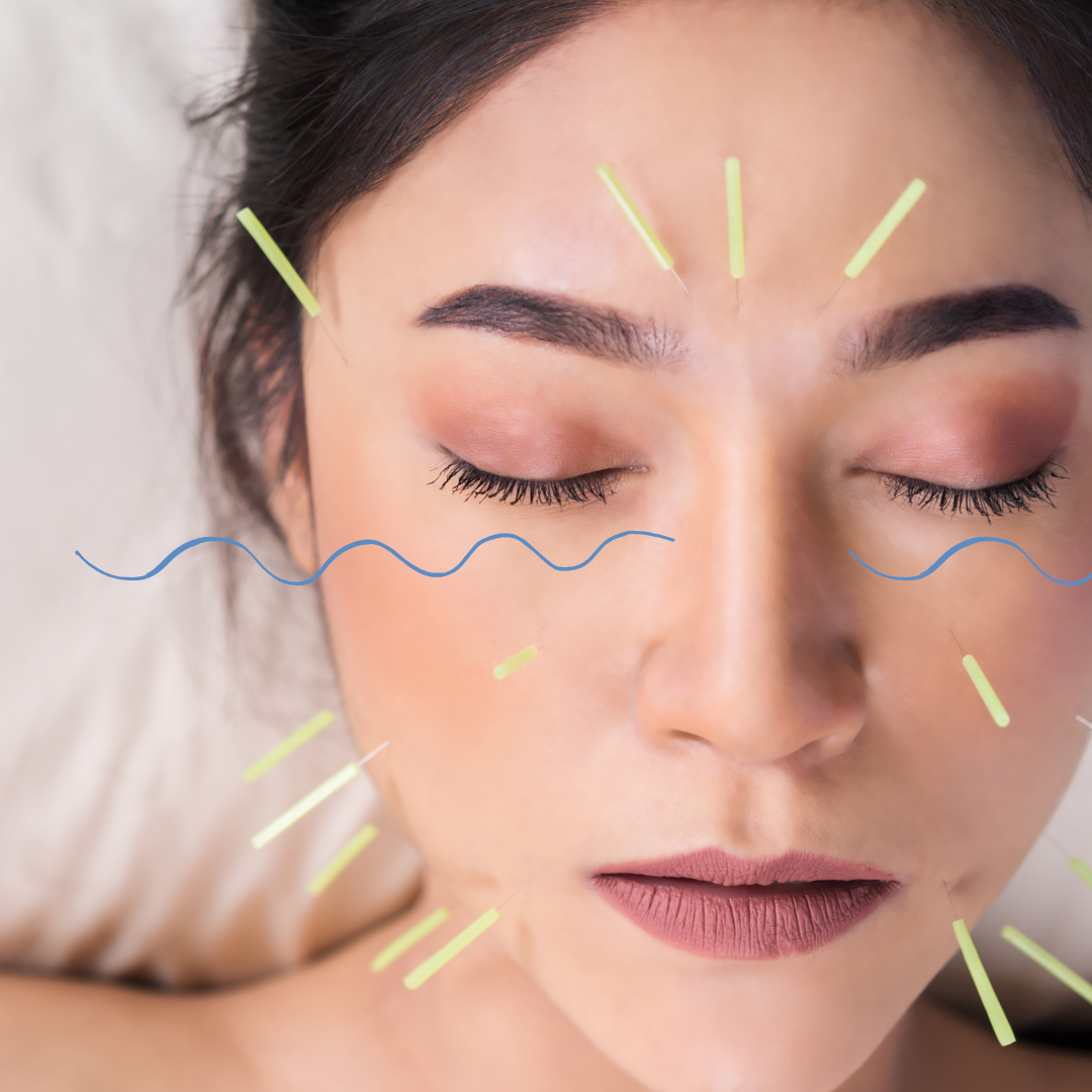 Acupuntura facial