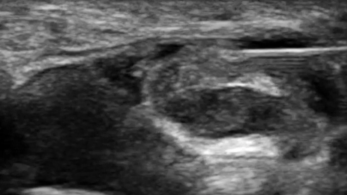 Abstract image representing selective image-guided injection.