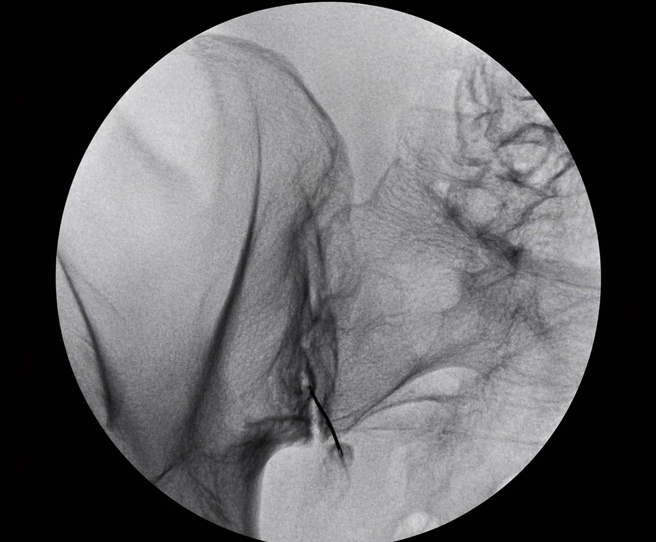 Fluoroscopic image of a sacroiliac joint injection.